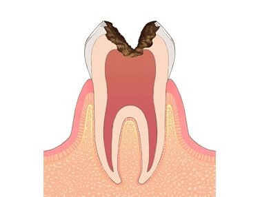 虫歯の原因は？