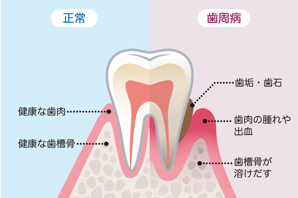 歯周病治療