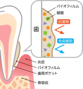 歯磨きだけでは虫歯・歯周病は予防できません