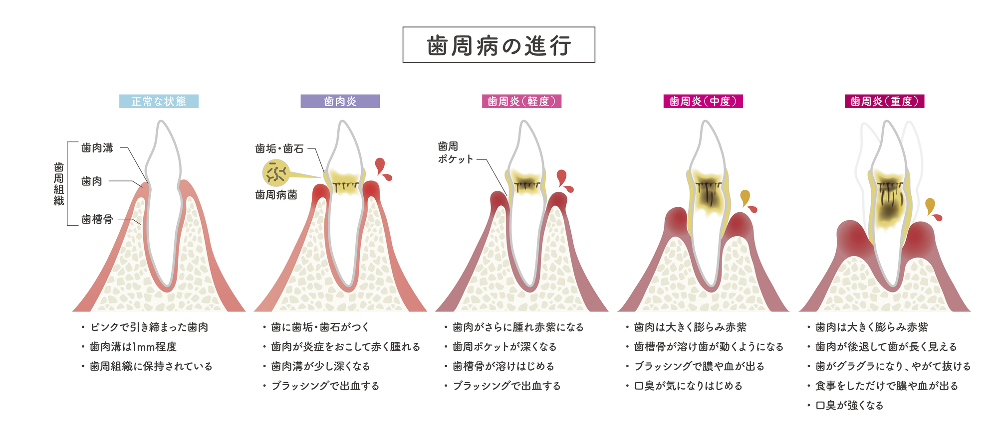 ステージ別歯周病治療